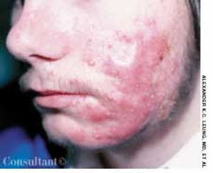 Refractory Acne Vulgaris in a 16-Year-Old Boy