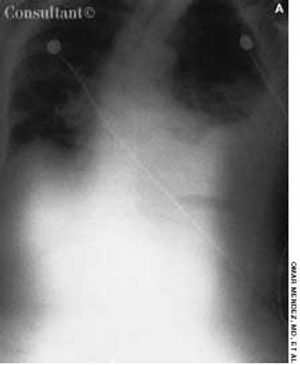 Boerhaave Syndrome