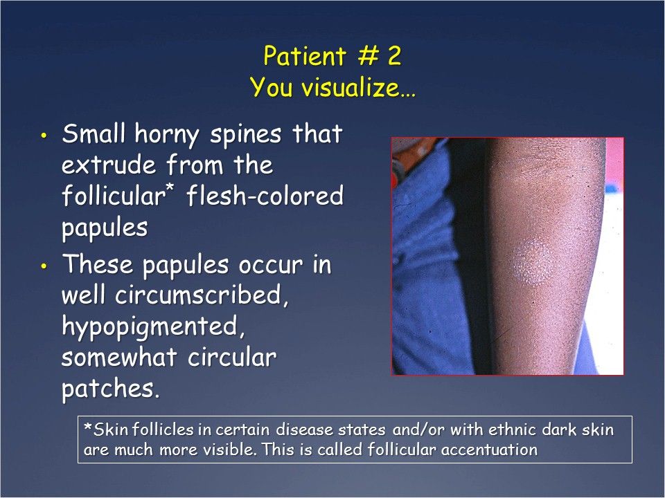 Lichenoid Eruptions: Can You Match that Rash with the Dx?