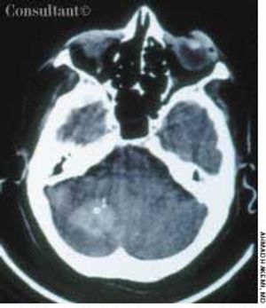 Cerebellar Hemorrhage in Woman With History of Hypertension