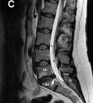 Oral Steroids for Acute Radiculopathy?