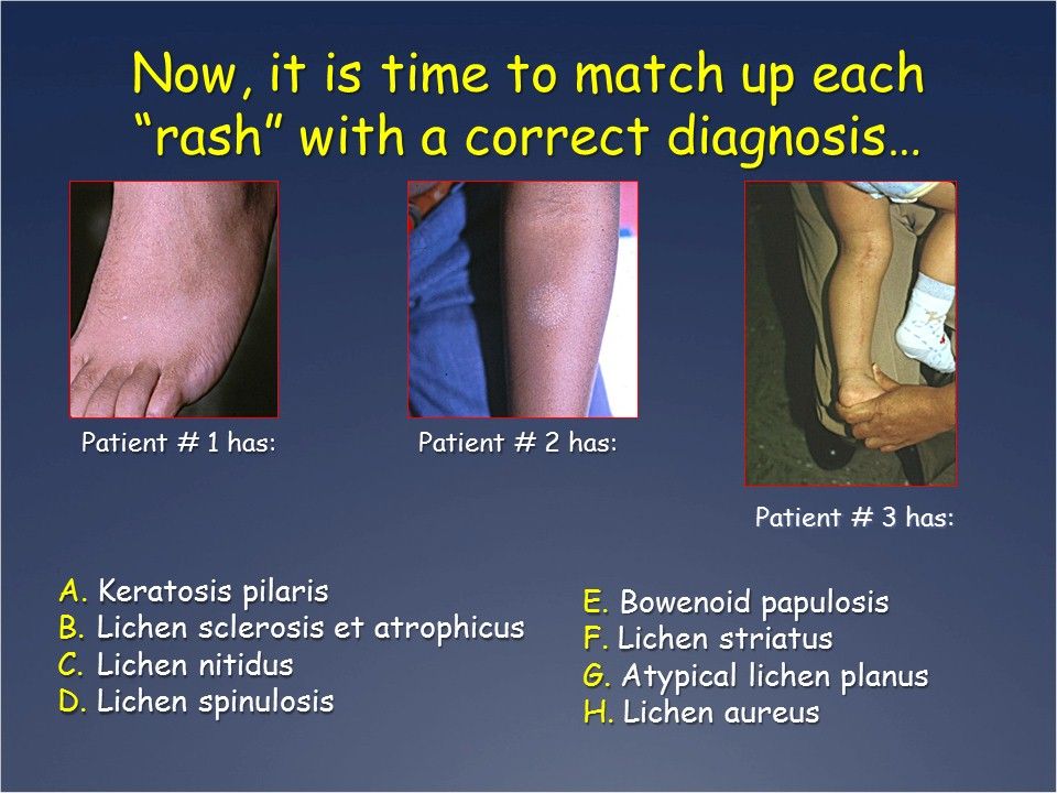 Lichenoid Eruptions: Can You Match that Rash with the Dx?