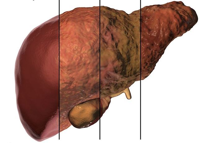 It's High Time to Retire NAFLD: Multinational Liver Societies Explain  