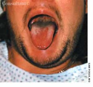 Mucous Membrane Necrosis Secondary to OTC Bronchodilator Overuse