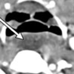 Retropharyngeal Abscess