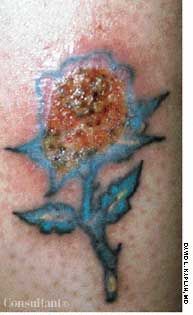 Infected Tattoo in a Patient with Diabetes
