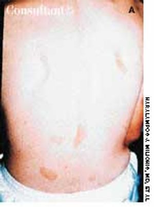 Neurofibromatosis