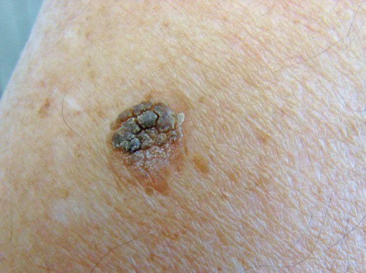 A Routine Seborrheic Keratosis