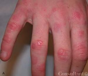 A Natural History of Granuloma Annulare