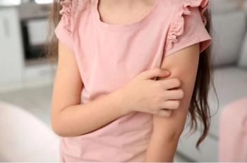 Atopic Dermatitis: Final ADORING 3 Open-Lael Extension Trial Findings with Tapinarof 1% Announced / image credit atopic dermatitis concept ©New Africa/stock.adobe.com