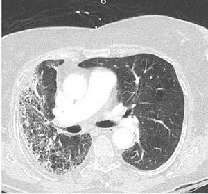 Progressive Pulmonary Symptoms in an Elderly Woman