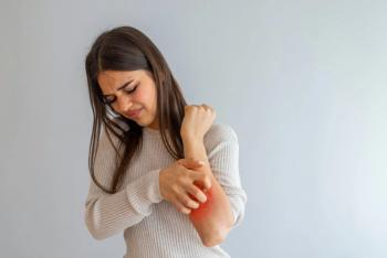 Lebrikizumab Therapy Improved QoL, Mental Health Outcomes in Patients with Atopic Dermatitis / Image credit: ©Dragana Gordic/AdobeStock