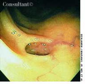 Diverticulosis in an Elderly Woman