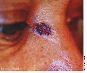 Basal Cell Carcinoma on Face of a 54-Year-Old Farm Worker