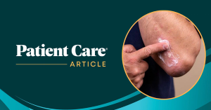 Nationwide Survey Finds Widespread Concern About Topical Steroid Use, Emphasizes Need for Long-Term Management Strategies in Chronic Inflammatory Skin Disease