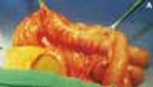 Eccentric Pigmentation A Clue to Malignant Melanoma in Situ