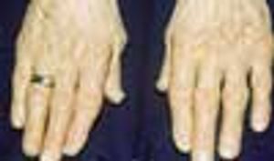 Inflammatory Seronegative Arthritis