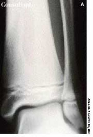 Brodie's Abscess