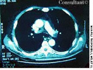 Pulmonary Embolism