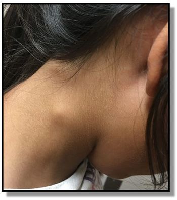 Lymphadenopathy, lymphadenitis, lymphoma, pneumonia, abscess