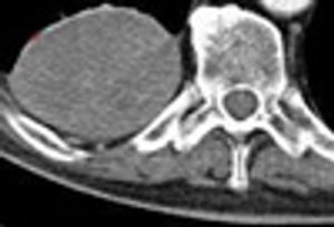 Solitary Fibrous Tumor of the Pleura
