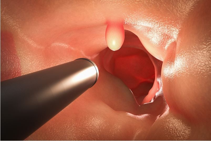 Automated system may help detect polyps during colonoscopy 