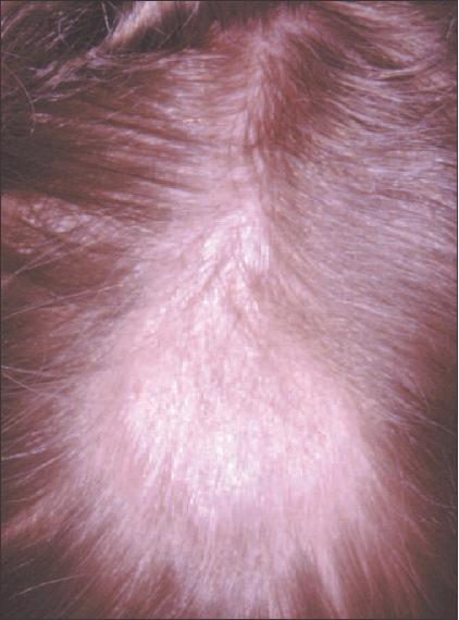 Differentiating the Types of Tinea | Patient Care