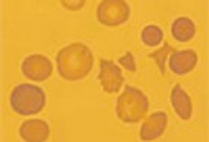 E coli O157 Infections: 5 Things Primary Care Physicians Need to Know Now