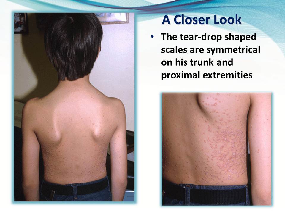 A Young Male with a Rash of Scales