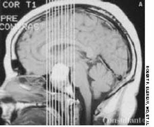 Pituitary Macroadenoma With Hemorrhage