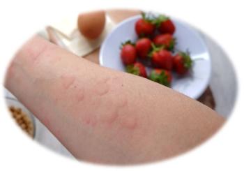 Omalizumab Efficacy and Safety Superior to OIT in Multi-Food Allergy Treatment/ image credit ©wisely/stock.adobe.com