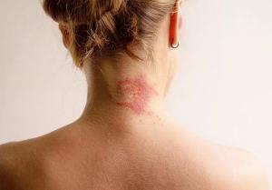Atopic Dermatitis in Focus: 3 Expert Pearls for Primary Care