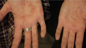 Pustular Psoriasis
