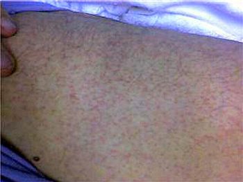 dengue fever rash