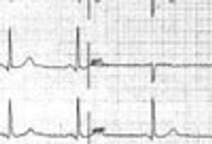 Organophosphate Poisoning Presenting as Syncope