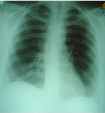 chest film, flank and abdominal pain