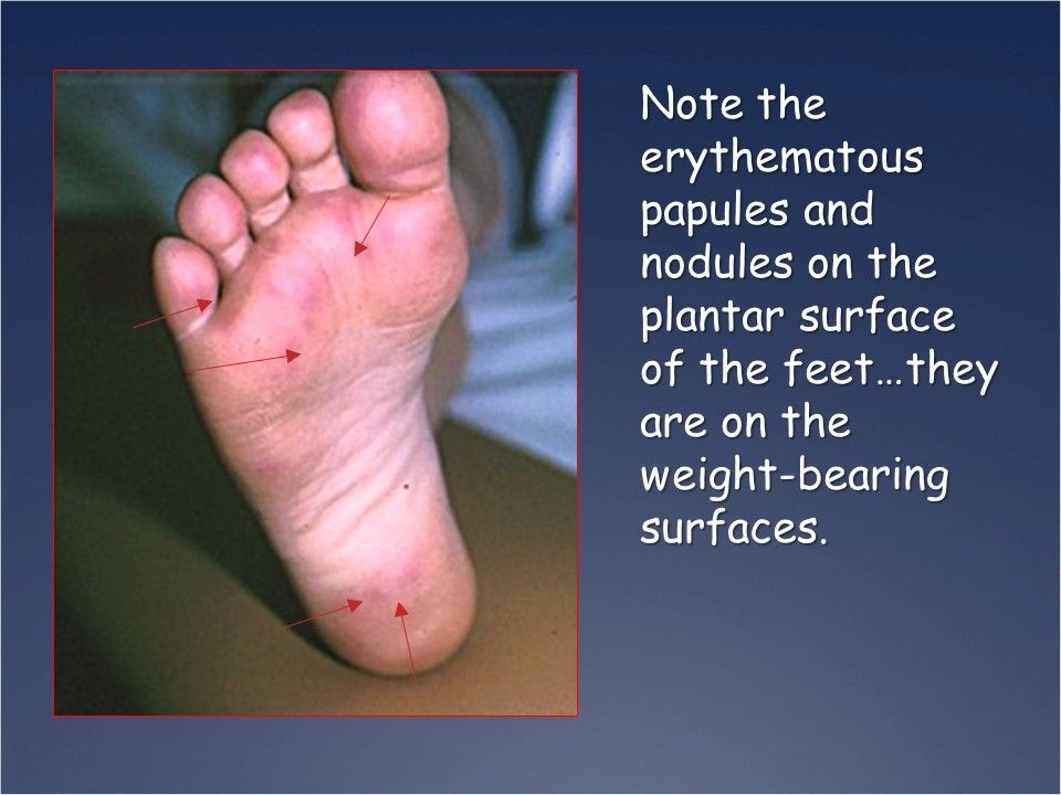 Sudden Painful Bumps On The Feet Of A Child