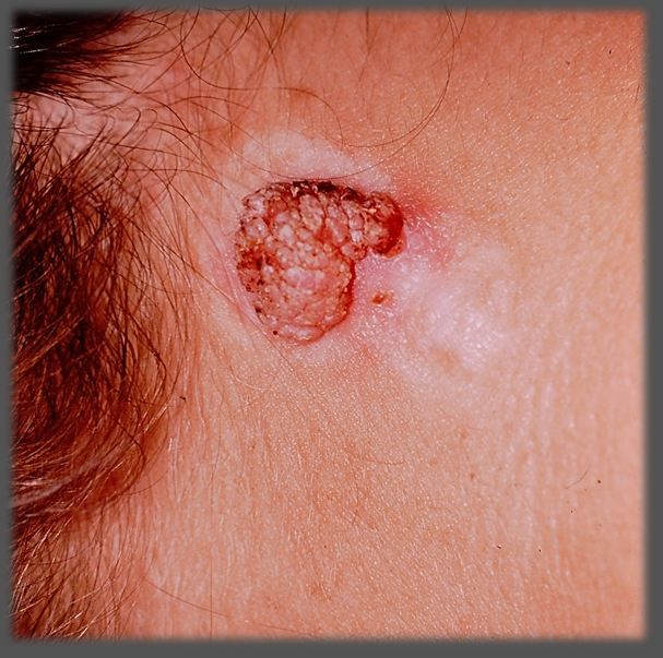 A Warty, Fungating Lesion | Patient Care Online