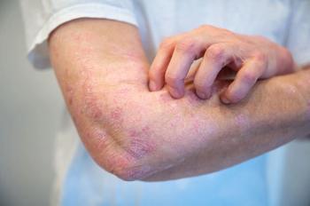Evidence-Based Management of Papulosquamous Disorders in Primary Care / image credit ©Daniel Beckemeier/stock.adobe.com 