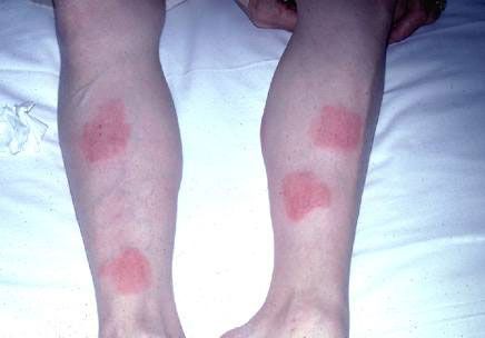 Allergic Reaction To Conducting Gel Used Under Ecg Electrodes Allergic Reaction To Conducting Gel Used Under Ecg Electrodes