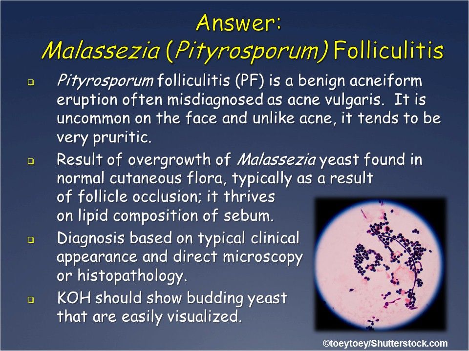 Pityrosporum folliculitis; benign acneiform eruption often misdiagnosed acne