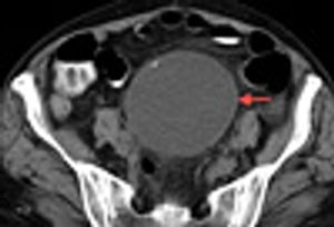 A Rare Retroperitoneal Pseudocyst in a Woman With Ulcerative Colitis