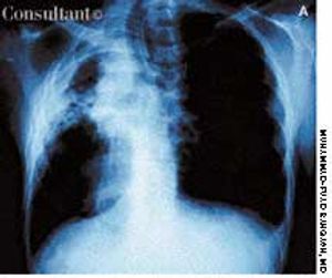 Aspergilloma, or Fungus Ball