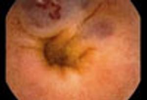 Blue Rubber Bleb Nevus Syndrome