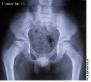 Legg-Calvé-Perthes Disease Presenting With Limp and Knee Pain