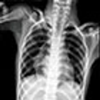 chest film, pneumonia