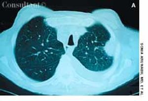 Adenocarcinoma of the Lung in a 67-Year-Old Man