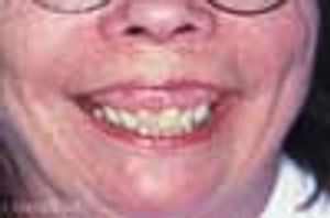 Paget Disease of the Maxilla