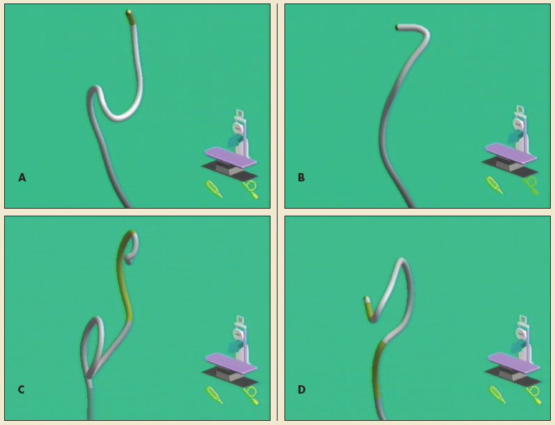 Looping Colon Colonoscopy: A Guide to Endoscopic Screening and Therapy