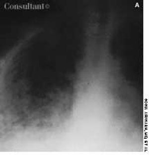 Multiple Lung Neoplasms